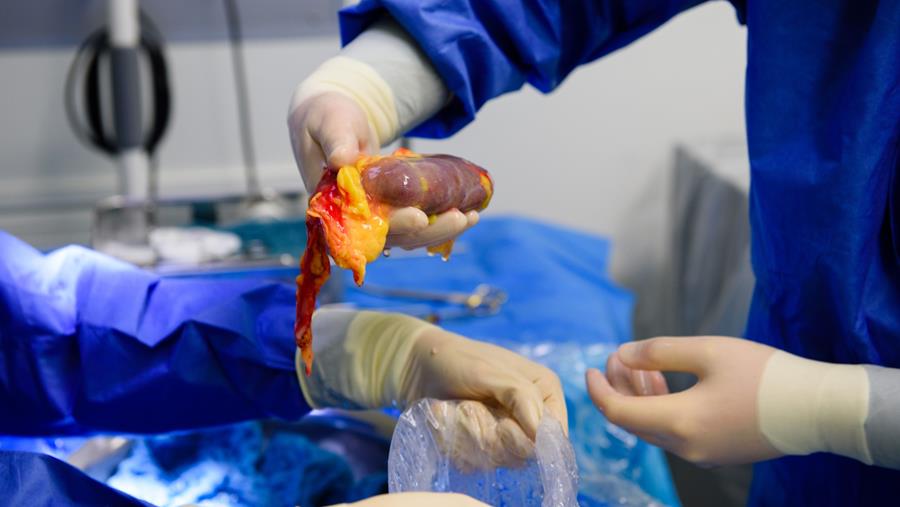 Nieuwe tool brengt afstoting na niertransplantatie beter in kaart